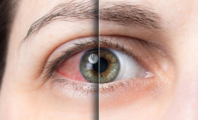 What Causes Eye Redness? What is Good for It? How Does It Treated?